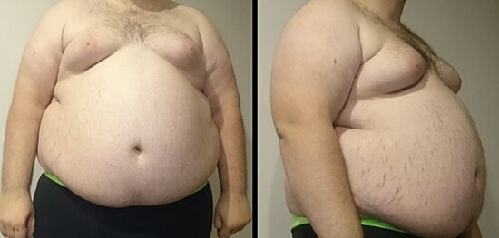 Sindrom Metabolik